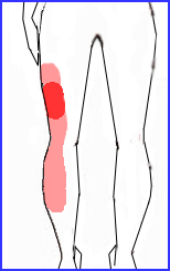 椎間板ヘルニア 図３　70.jpg